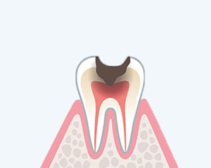 虫歯の種類 イメージ3